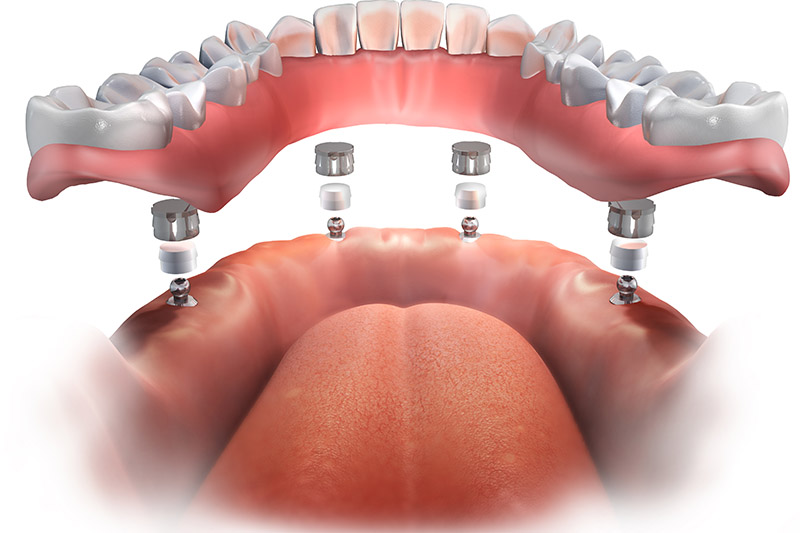 All on 4 Dental Implants in Glenview