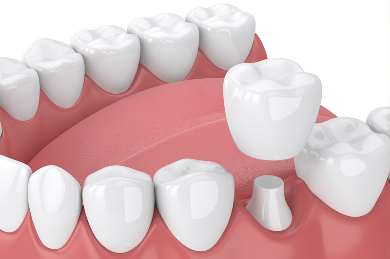 Dental Crowns in Glenview