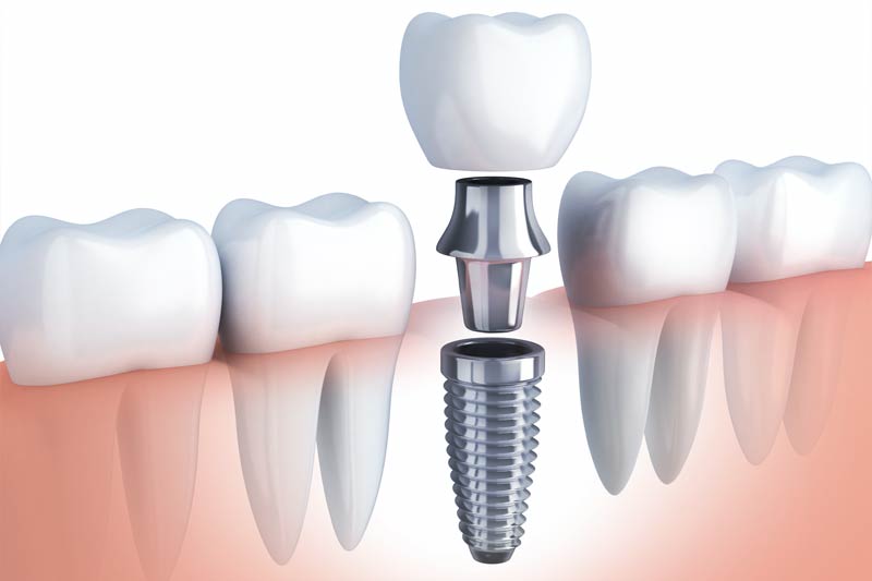 Implants Dentist in Glenview